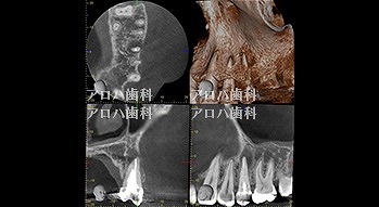 根尖部に透過像