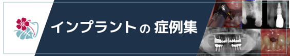 インプラント症例